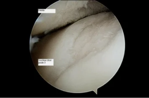 uri ng astroscope sa kasukasuan ng tuhod na may osteoarthritis ng 3rd degree