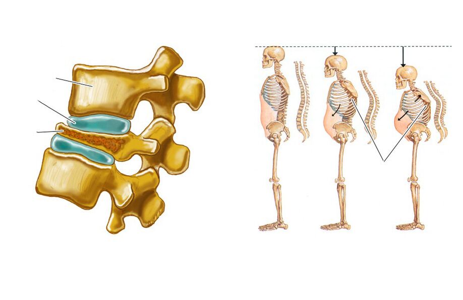 ang sagging spine ay humahantong sa pananakit ng likod