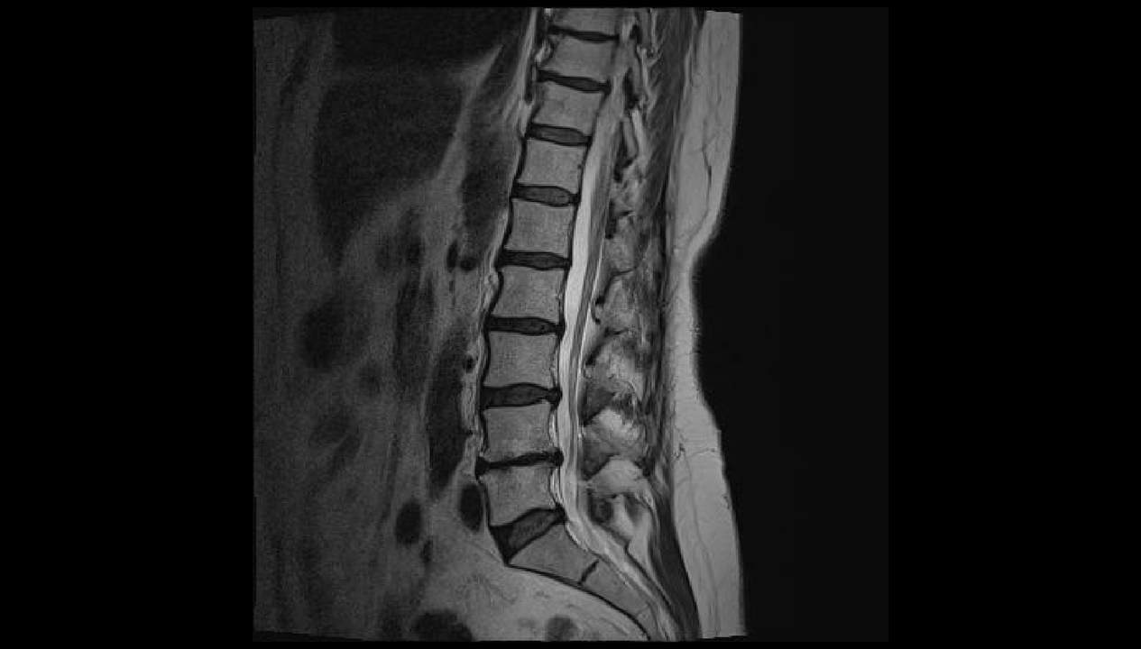 diagnosis ng sakit sa likod sa rehiyon ng lumbar