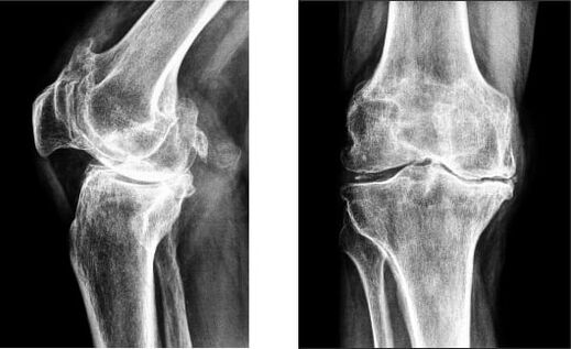 Gonarthrosis ng tuhod sa x-ray