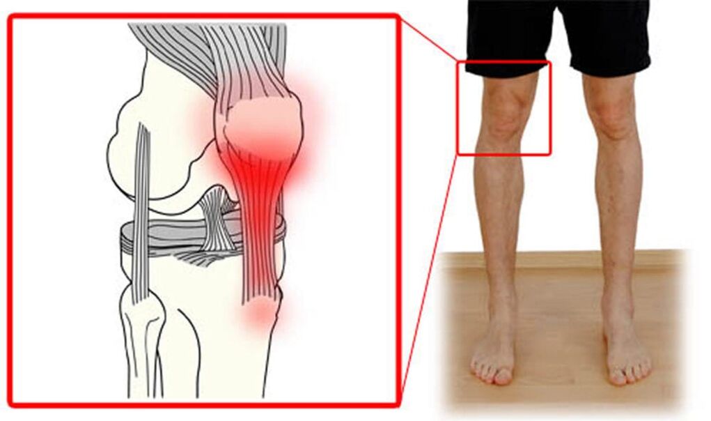 Tendinitis - pamamaga ng mga tendon sa kasukasuan ng tuhod