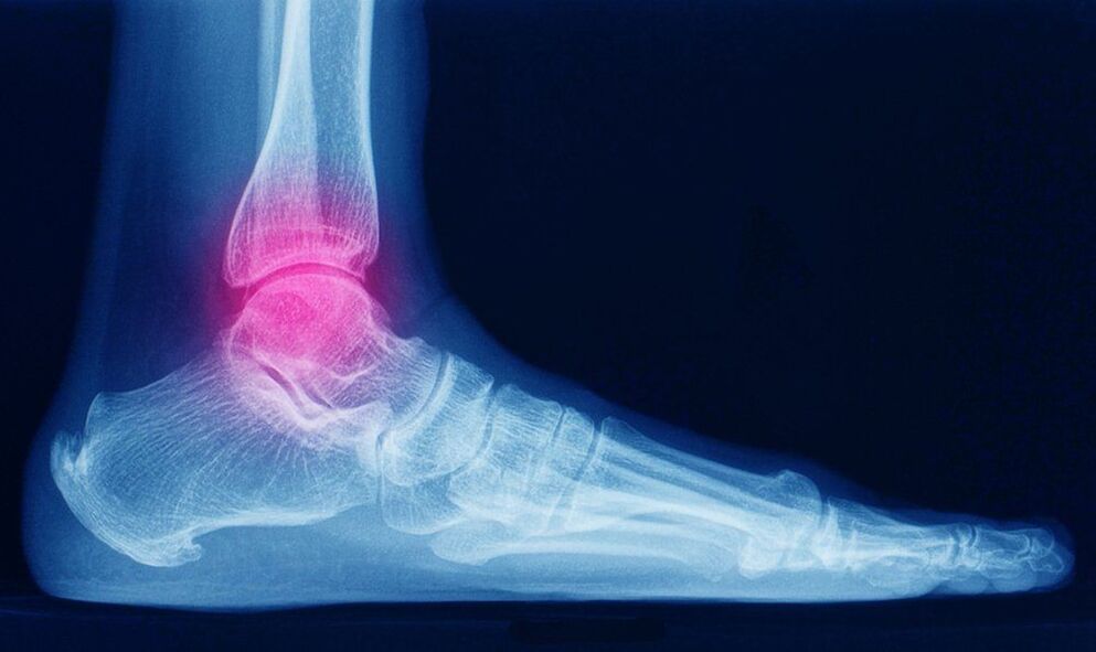 sintomas ng ankle arthrosis