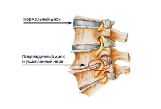 Ang mga sintomas ng cervical degenerative disc sakit