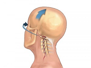 kung paano nagpapakita ng osteochondrosis ng servikal gulugod