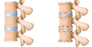 kung paano makilala ang pagkakaroon ng osteochondrosis ng lumbar gulugod