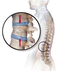 Ang Osteoporosis ay pumupukaw ng sakit sa likod sa rehiyon ng lumbar